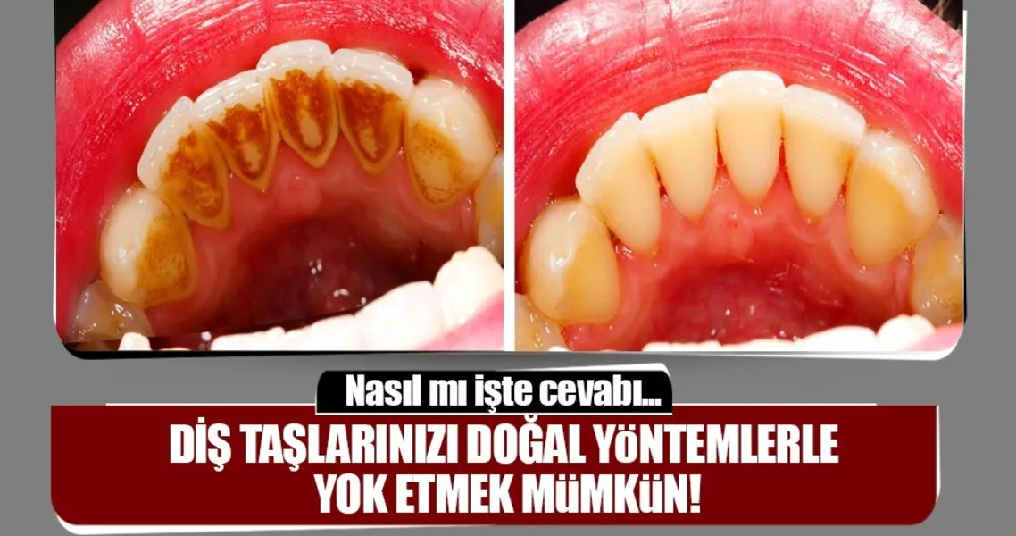 dis taslarinizi dogal yontemlerle yok etmek artik mumkun saglik haberleri dis taslarinizi dogal yontemlerle yok etmek artik mumkun saglik haberleri