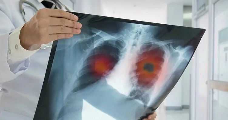 Koah Hastaligi Nedir Belirtileri Nelerdir Koah Hastaliginin Tedavisi Nasil Yapilir Sayfa 2