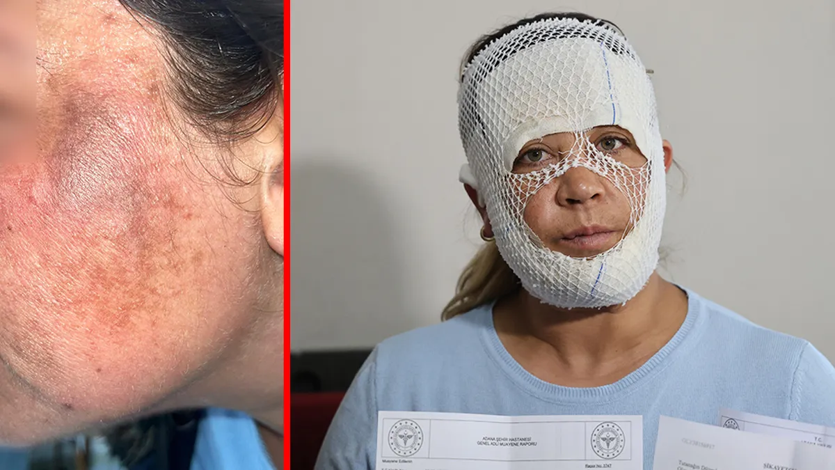 Adana’da ‘Prenses cilt bakımı’ kabusu oldu! Güzellik uğruna hayatı karardı: “Çocuğum ‘öcü’ diyerek benden kaçıyor” Adana’da ‘Prenses cilt bakımı’ kabusu oldu! Güzellik uğruna hayatı karardı: “Çocuğum ‘öcü’ diyerek benden kaçıyor”