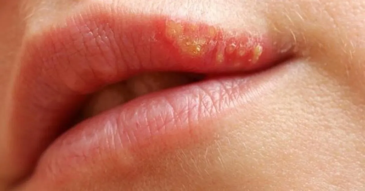 dudakta ucuk neden cikar dudaktaki