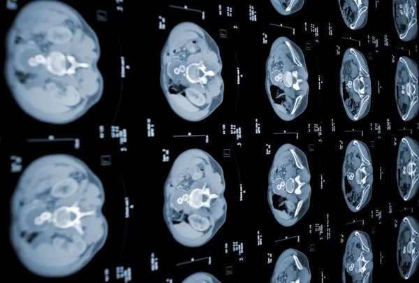 pankreas kanseri belirtileri nelerdir