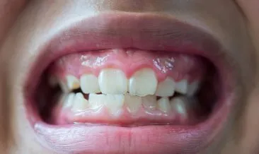 Uzmanı anlattı: Günde 3 defadan fazlası diş erozyonunu 37 kat artırıyor!