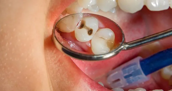 cektirmeyin kanal tedavisi yaptirin