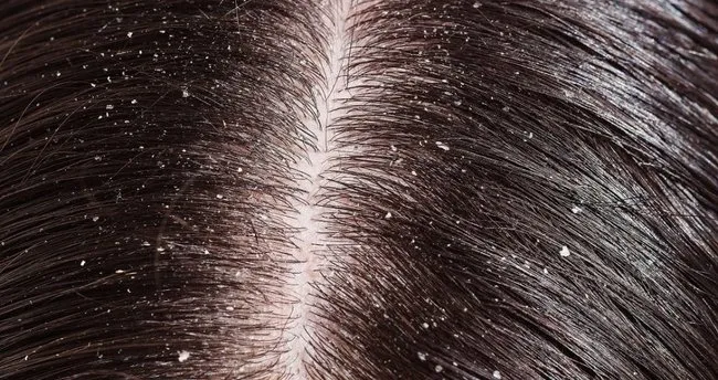 Sac Neden Kepeklenir Sac Kepeklenmesi Dogal Ve Bitkisel Yollardan Nasil Gecer Saglik Haberleri Sac Neden Kepeklenir Sac Kepeklenmesi Dogal Ve Bitkisel Yollardan Nasil Gecer Saglik Haberleri