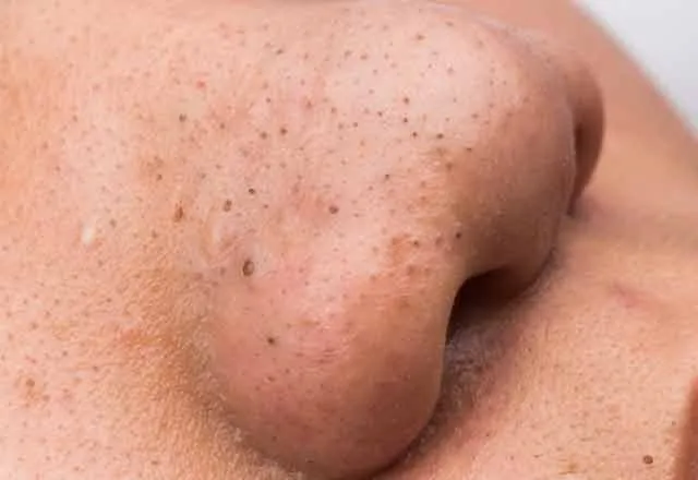 Siyah nokta temizleme yöntemleri