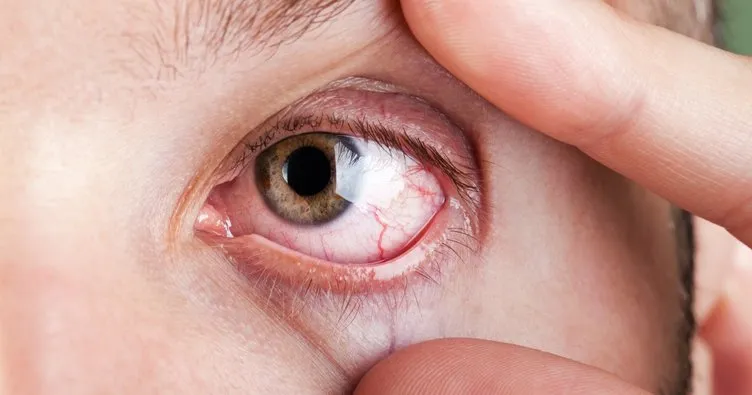 Göz kızarıklığının nedeni 'kuruluk' olabilir - Sağlık Haberleri