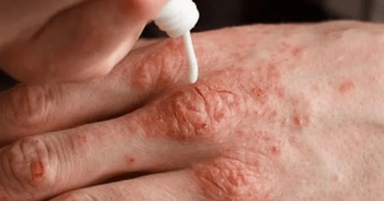 Soğuk havanın alerjisi mi olur demeyin!