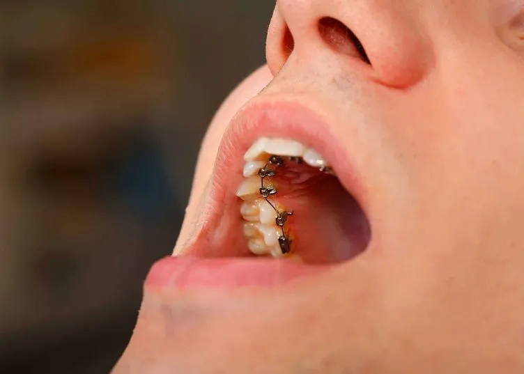 Çarpık dişlere gizli diş teliyle çözüm
