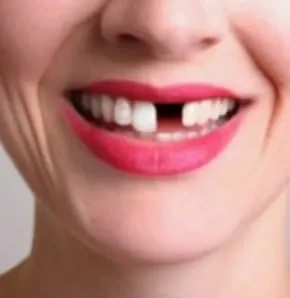 Eksik dişin 8 zararı