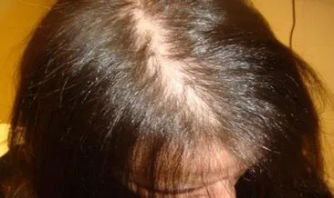 kadinlarda sac dokulmesinin nedenleri sac dokulmesi neden olur saglik haberleri