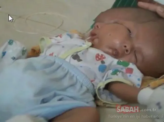 Endonezya’da iki yüzlü bebek dünyaya geldi!