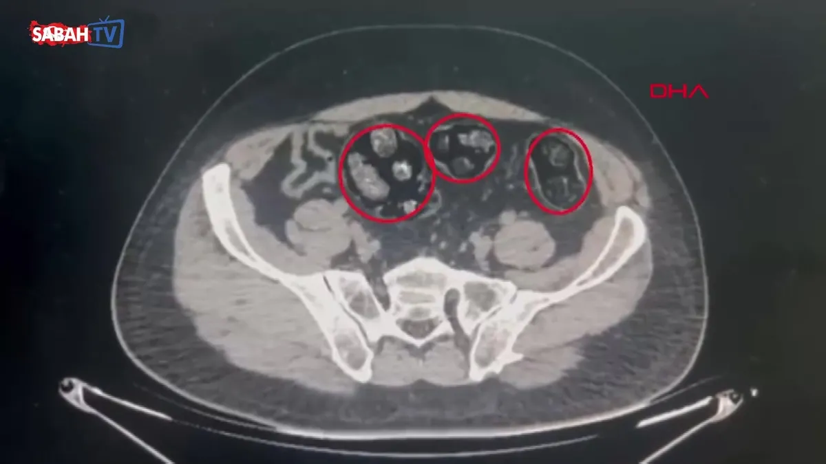Polisin durdurduğu yolcu otobüsünde şoke eden olay: Mide ve bağırsaklarından yarım kilo uyuşturucu çıktı | Video videosunu izle Polisin durdurduğu yolcu otobüsünde şoke eden olay: Mide ve bağırsaklarından yarım kilo uyuşturucu çıktı | Video videosunu izle