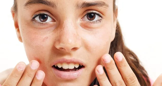 gunes lekesi giderici krem tedavisi