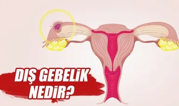 dis gebelik nedir dis gebelik nasil