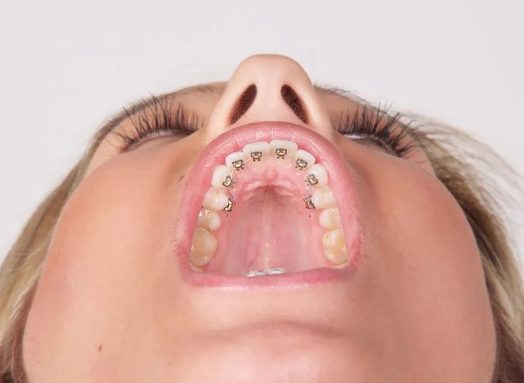 Çarpık dişlere gizli diş teliyle çözüm
