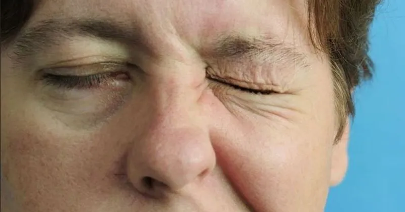 yuz felci neden olur yuz felci