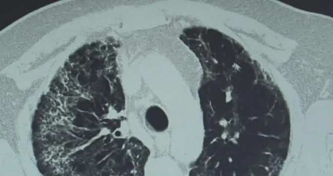 Son Dakika Corona Virusu Akcigerinin 80 Nini Kaplamisti Iyilesti Son Dakika Haberler