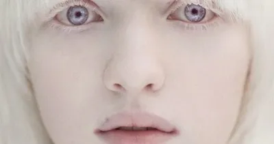 Albinizm hastalığı nedir? Tedavisi mümkün müdür?