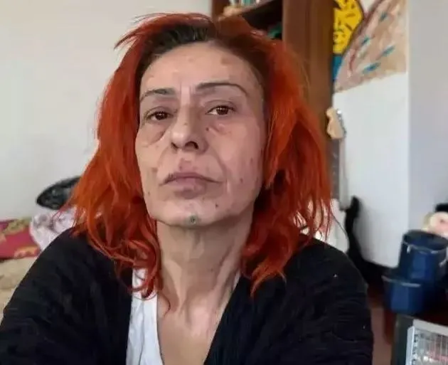 Saç boyası yüzünü yakmıştı! Yıldız Tilbe şimdi de yüzündeki beneklerle gündem oldu...