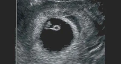 Hafta hafta ultrason görüntüleri