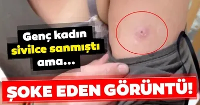 O görüntüler herkesi şoke etti! Genç kadın basit bir sivilce sanmıştı ama…