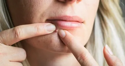 Sivilceleri kuruttuğu ortaya çıktı! İşte sivilceyi kurutan inanılmaz gıdalar