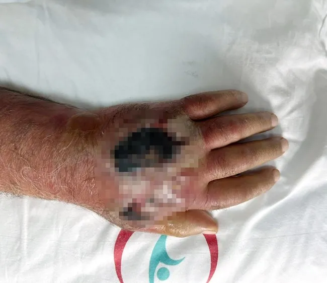 Üsküdar’da yok artık dedirten olay! Elini ısıran hırsız yüzünden kolu kesilecekti! Bizim için de bu bir ilk
