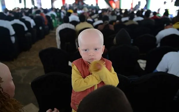 Kenya’daki albinolar büyücülerin kıskacında