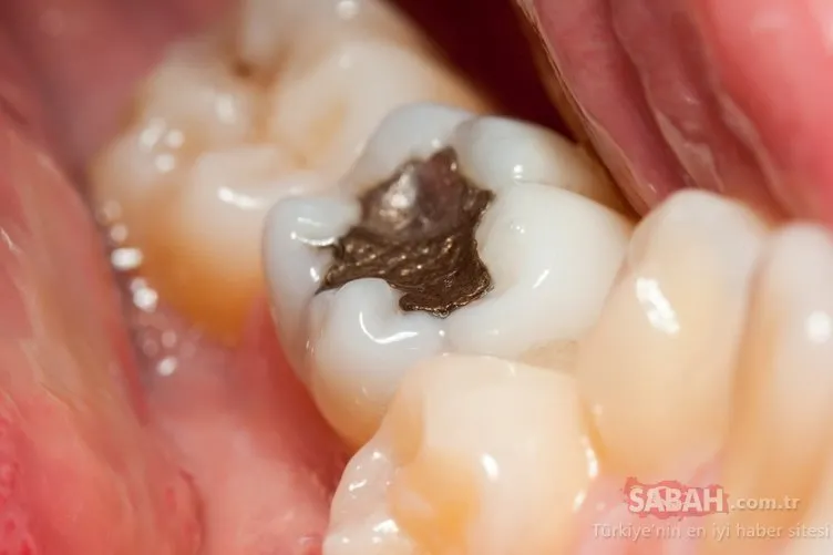 Diş çürüğüne engel olan besinler nelerdir? İşte diş çürüğünü ortadan kaldıran besinler