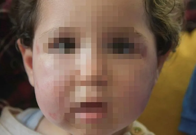 Kreşte skandal: 1,5 yaşındaki kız çocuğuna dayak iddiası!