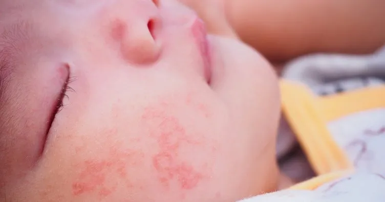 bebeklerde atopik dermatite karsi etkili oneriler bebek haberleri