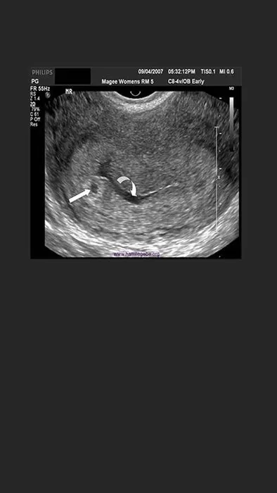 Hafta hafta ultrason görüntüleri