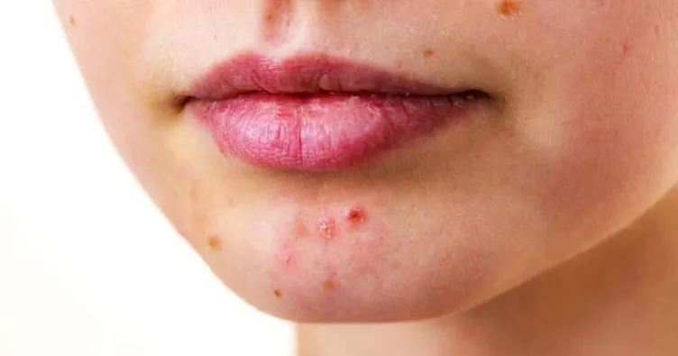 Sivilceleri sakın sıkmayın!