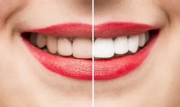 Dişleri beyazlatmak için 4 pratik yöntem!