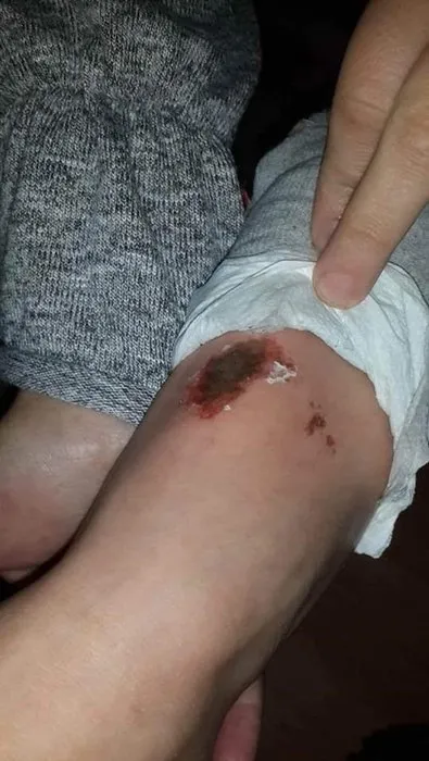 Kar topu oynarken vücutlarında yanık oluşan öğrencilerin sayısı 9'a çıktı