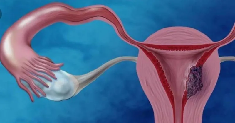 rahim kanseri belirtileri nasil