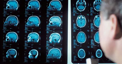 Tomografiyle tümörlerin teşhisinde artış