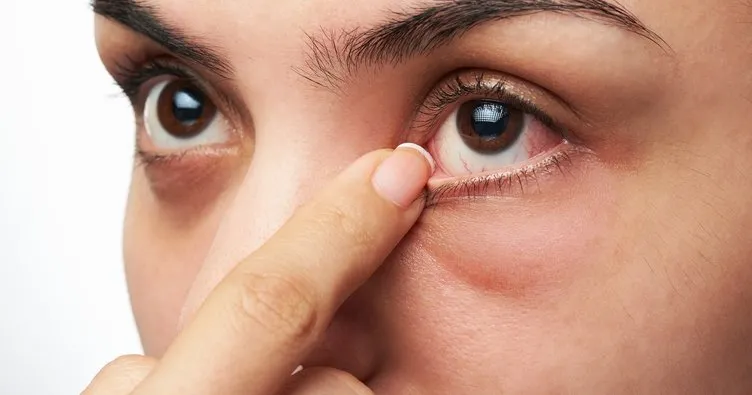 Göz alerjisi nedir? Göz alerjisinin belirtileri nelerdir?