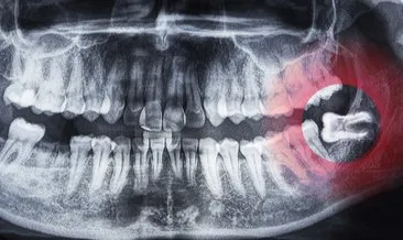 Çene ve ağız sağlığını bozuyor! Gömülü 20’lik diş sorununun çözümü...