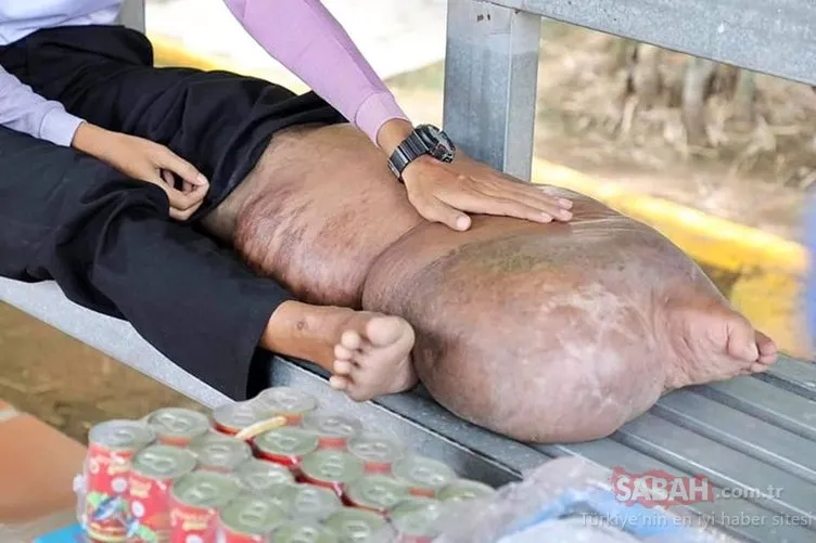 Kamboçya’da sivrisineğin ısırdığı adam görenleri hayrete düşürüyor