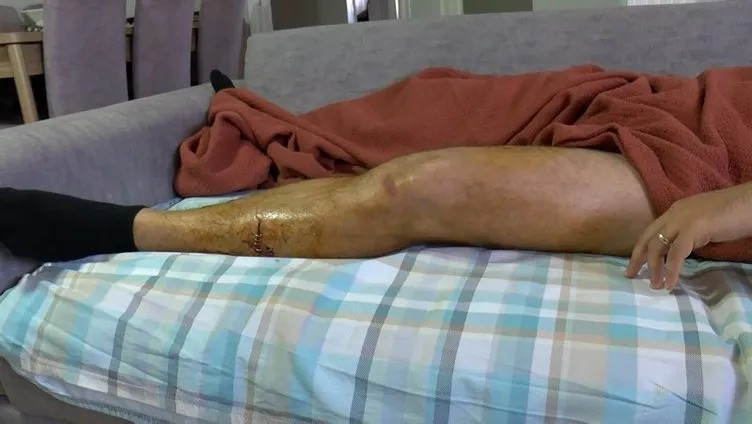 Pitbull saldırısı sonrası vücuduna 28 dikiş atıldı: Köpekle 8 dakika boğuştum!