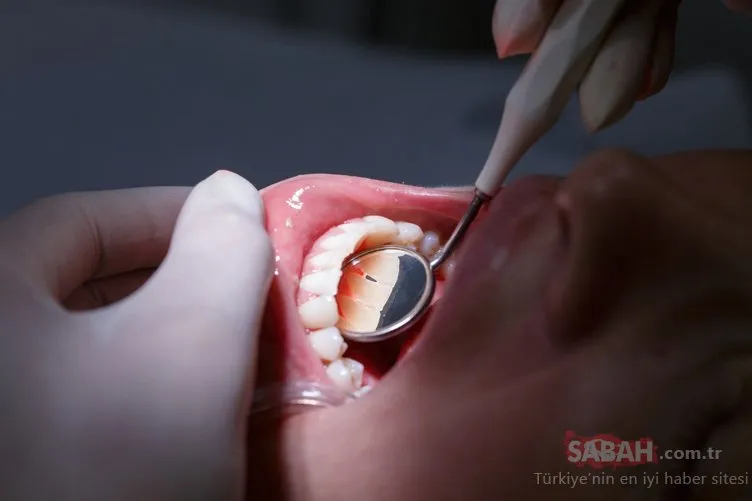 Diş taşı, diş kaybına neden olabilir!