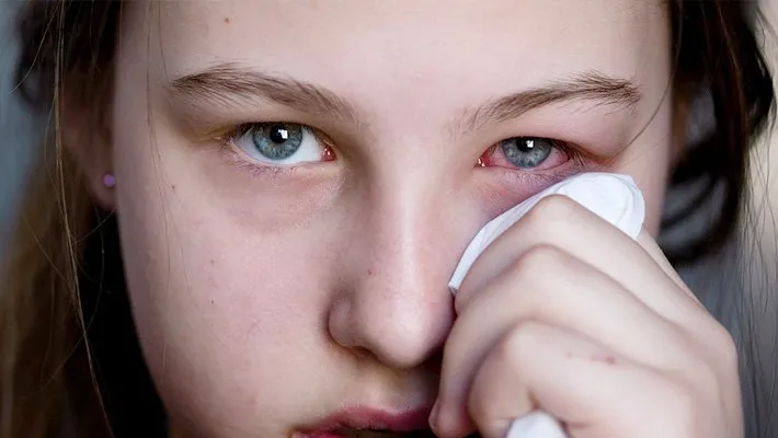 gozdeki agriya ne iyi gelir goz agrisi nasil gecer iste bitkisel ve dogal agri kesiciler saglik haberleri