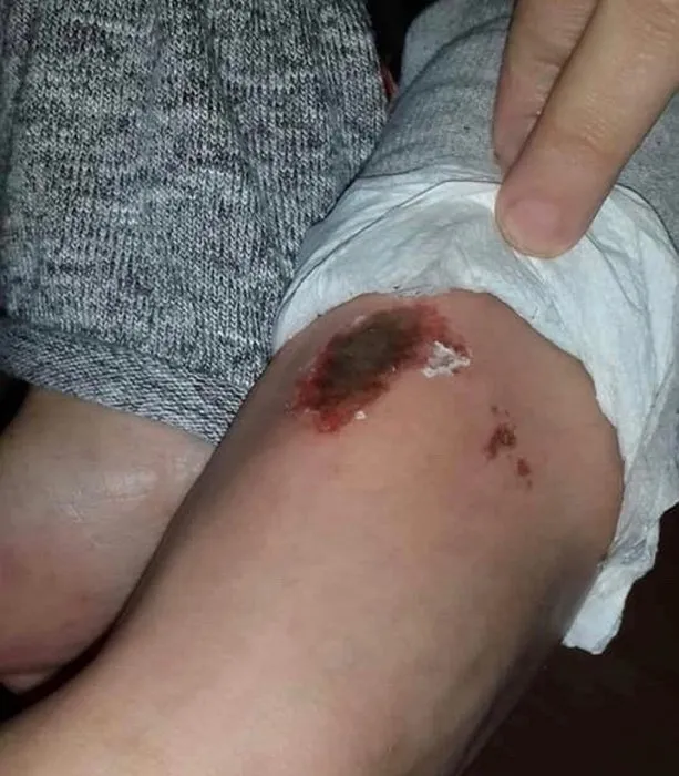 Kar topu oynarken vücutlarında yanık oluşan öğrencilerin sayısı 9'a çıktı