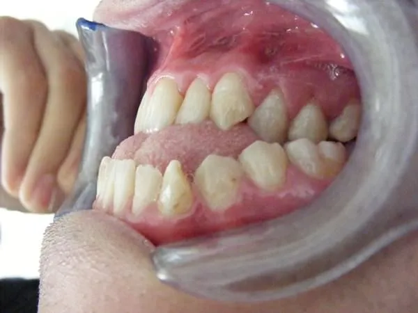 Diş bozukluğu