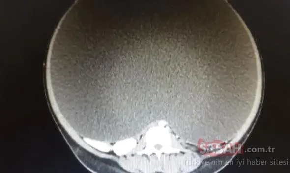 Doktorlar bile şok oldu! Bebeğini görmek için hastaneye gitti, karnından tam 26 kilo ağırlığında…