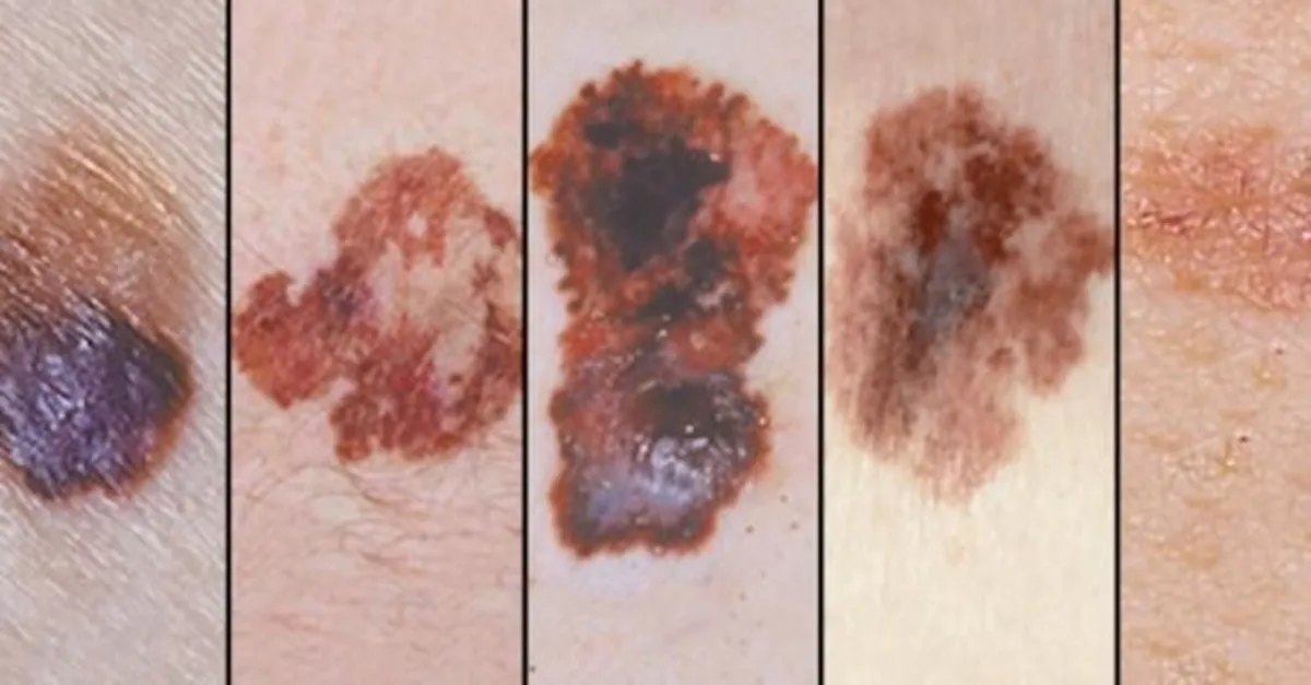 Kanserli Ben Nasil Anlasilir Agri Yapar Mi Ve Nasil Tedavi Edilir Son Dakika Haberler