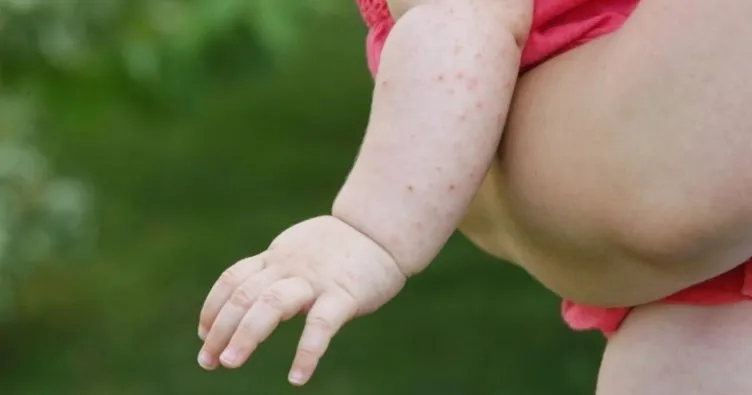 Bu durum çocuklarda gıda alerjisi riskini düşürebilir