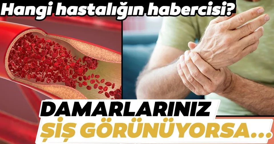 Damarlarınız böyle görünüyorsa dikkat!