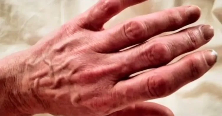 Koronavirüsün geçmeyen belirtileri şoke etti! Kadının vücudunda…